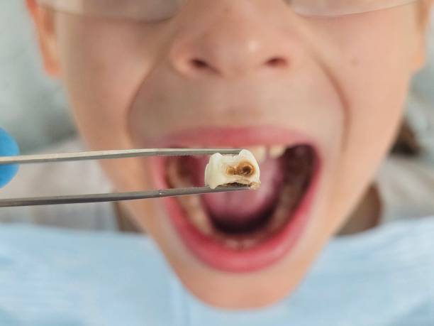 Best Emergency Wisdom Teeth Removal in Woodacre, CA
